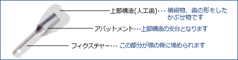 上部構造(人工歯)･･･補綴物、歯の形をしたかぶせ物です　アバットメント･･･上部構造の支台となります　フィクスチャー･･･この部分が顎の骨に埋められます