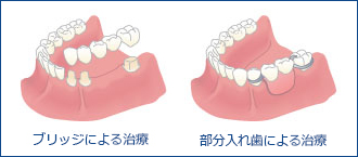ブリッジによる治療　部分入れ歯による治療　画像