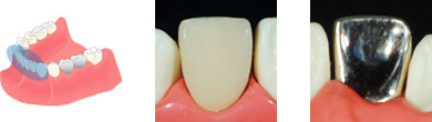 前歯の保険治療画像
